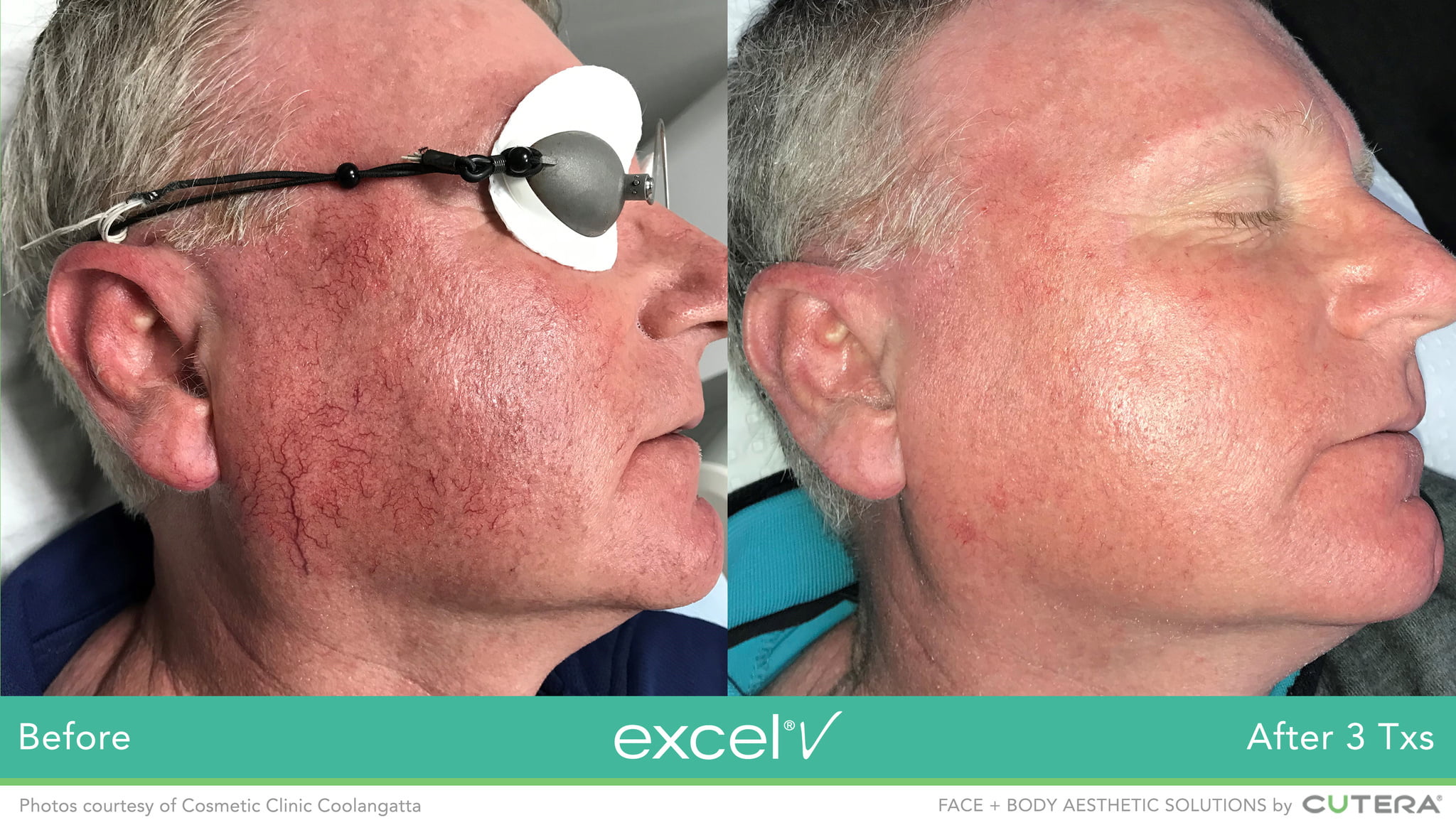 Man's side of face before and after laser treatment with excel V to erase redness and visible veins