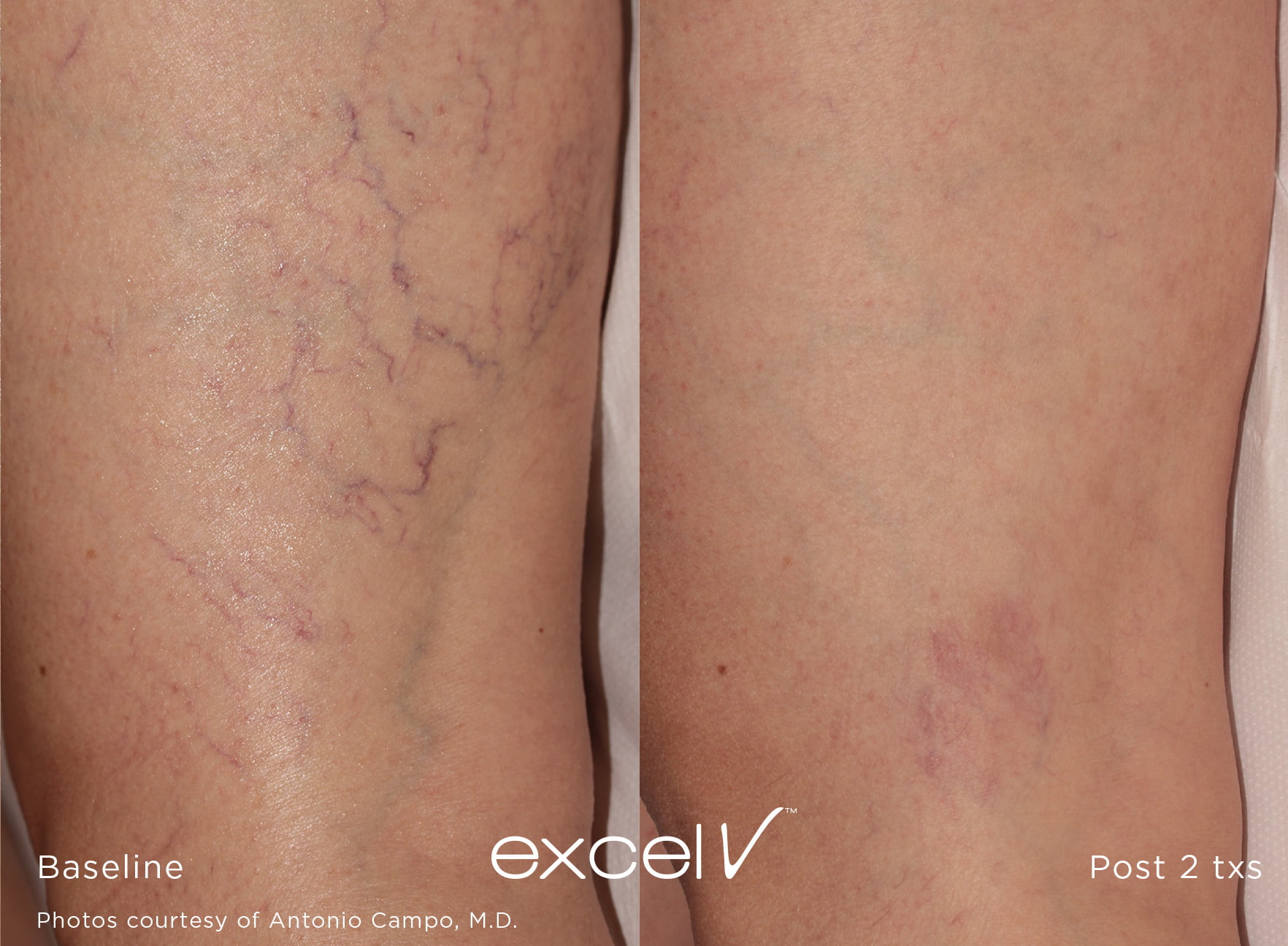 before and after of purple leg veins erased with excel v laser