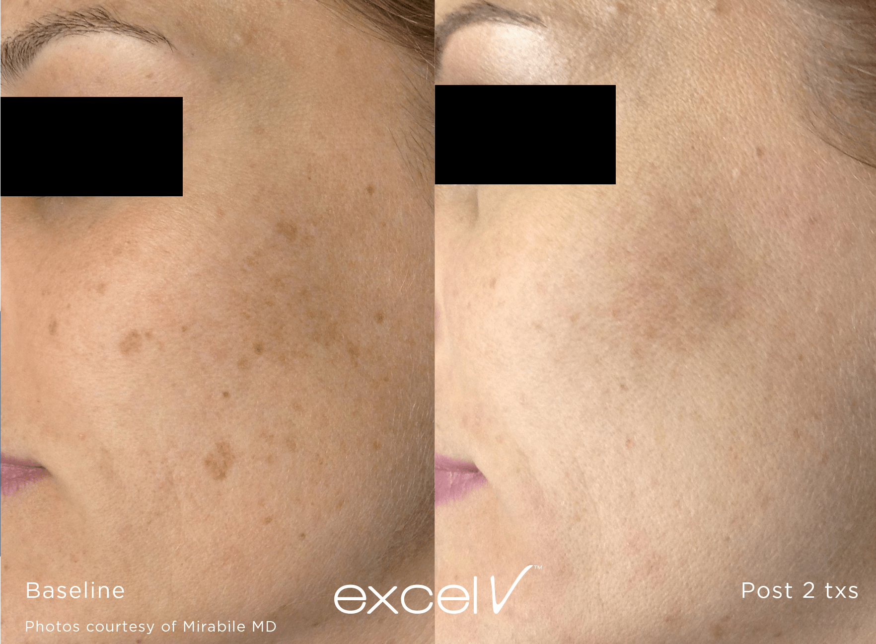 before and after photo of dark spot on cheek, erased with excel v laser