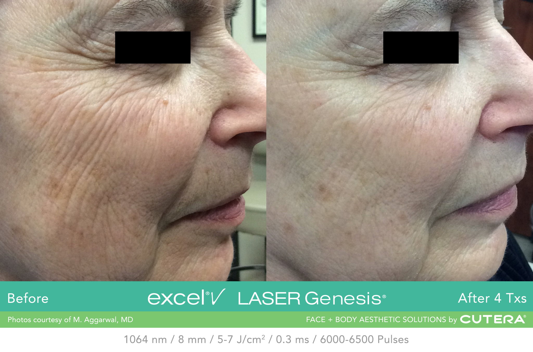 side of woman's face before and after treatment with excel v laser to soften fine lines, wrinkles, and brown age spots