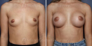Breast Augmentation with Nipple Reduction