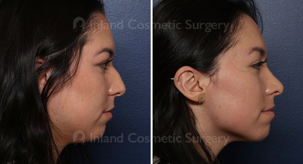 Rhinoplasty