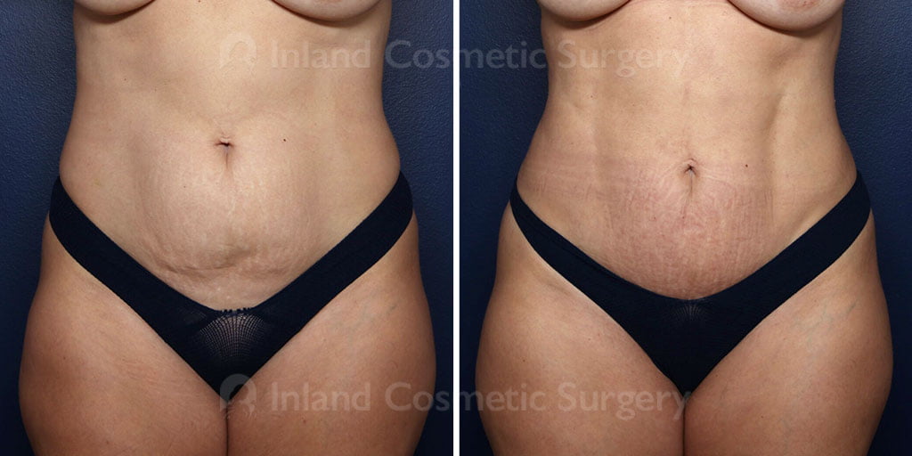Dermolipectomy with Liposuction