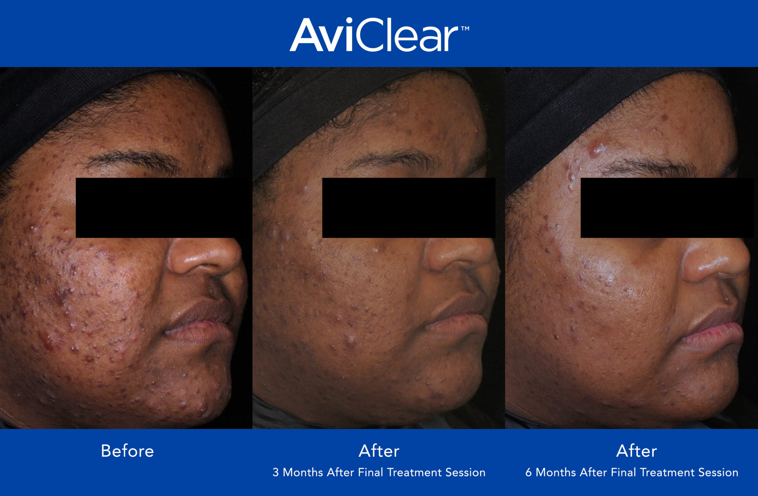 AviClear Rancho Cucamonga Acne Laser Treatment Ahava Medspa