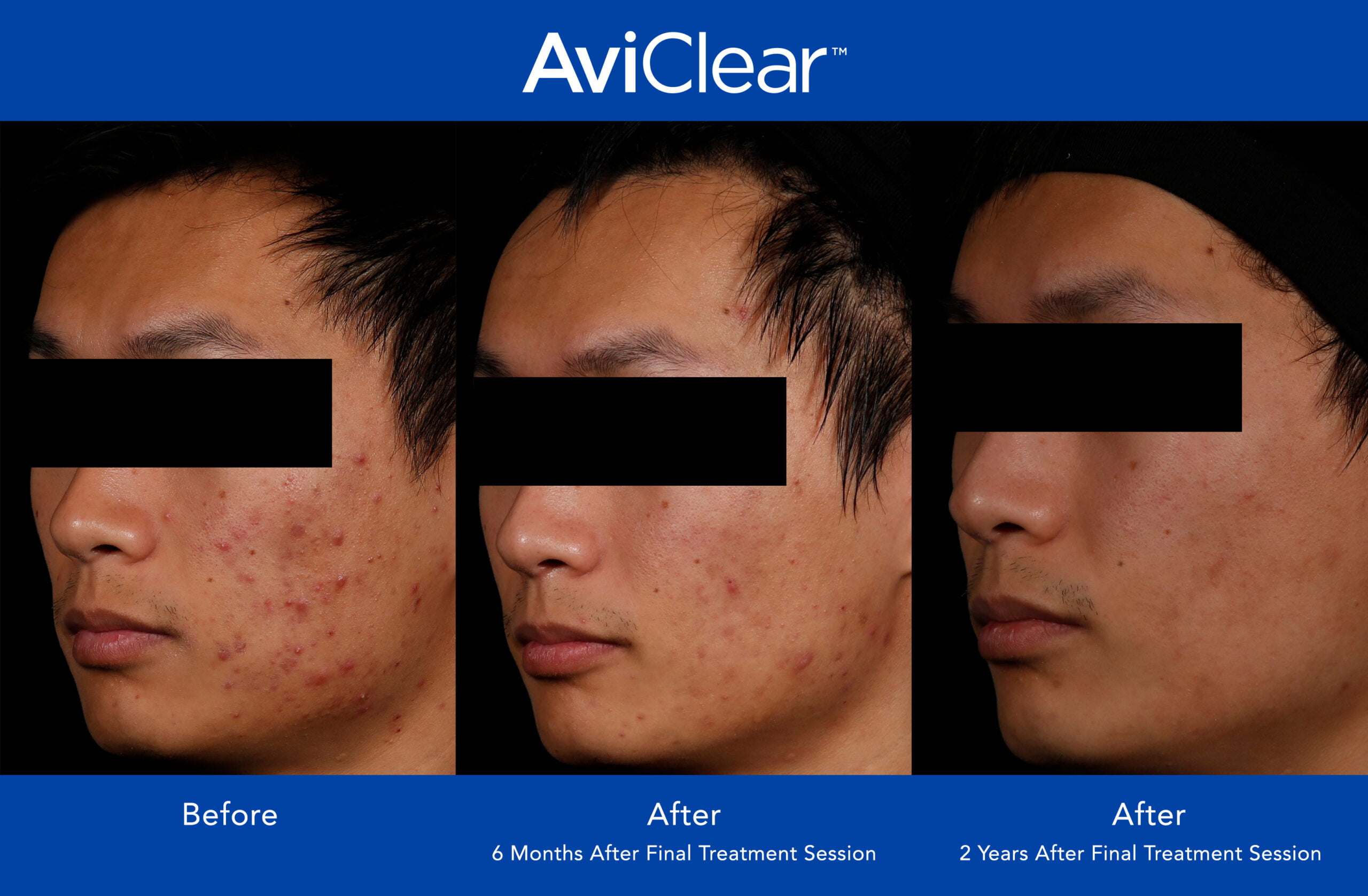 Before and after photo of a patient with facial acne.