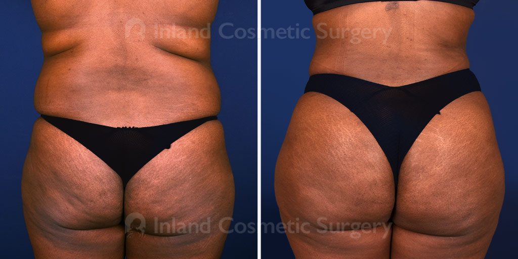 Real patient shown before and after brazilian butt lift fat transfer for improved back and body contour