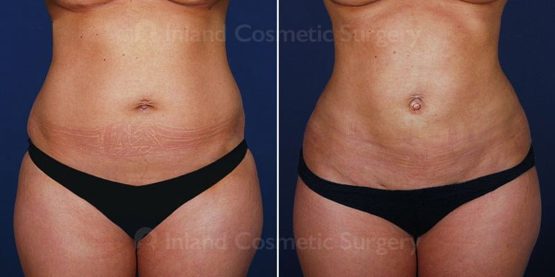 Patient results shown before and after liposuction treatment with cosmetic surgeon Dr. Tower. 