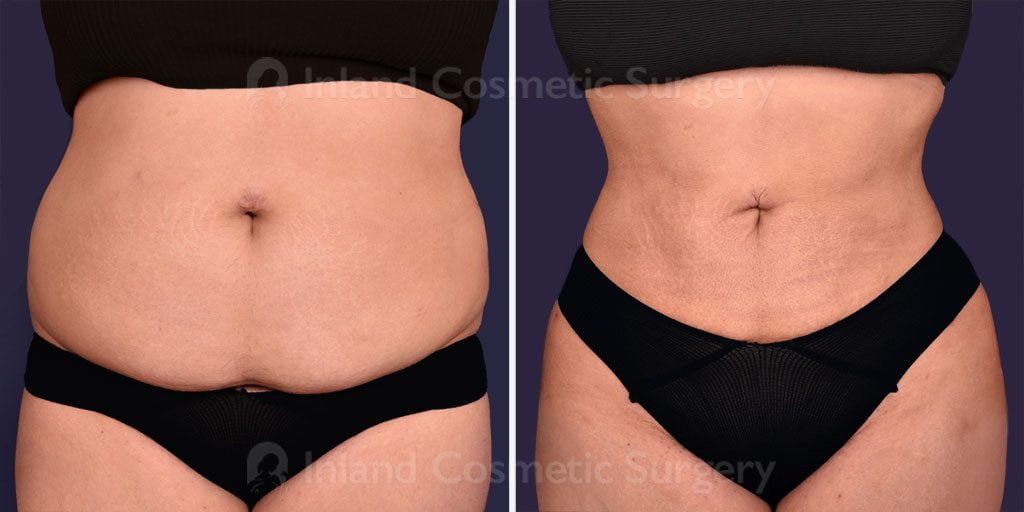 Real patient shown before and after treatment of the body, waist, and back. 