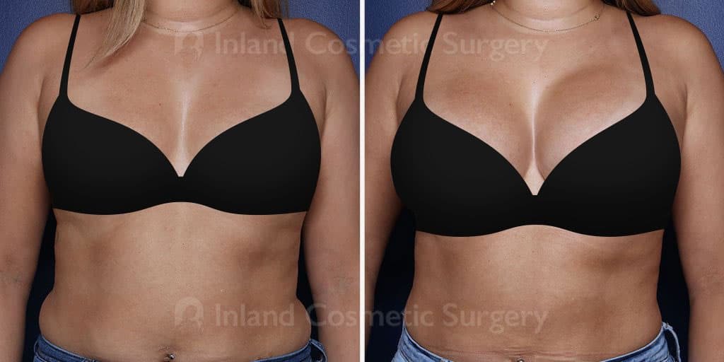 Inland Cosmetic Surgery in Rancho Cucamonga breast augmentation