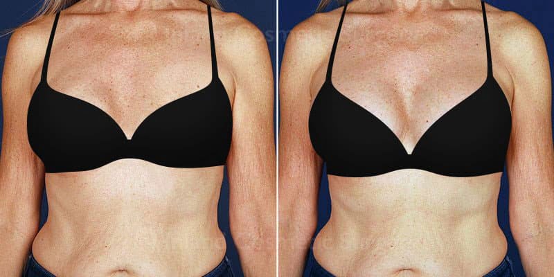 Image of our Inland Empire patient before and after breast revision