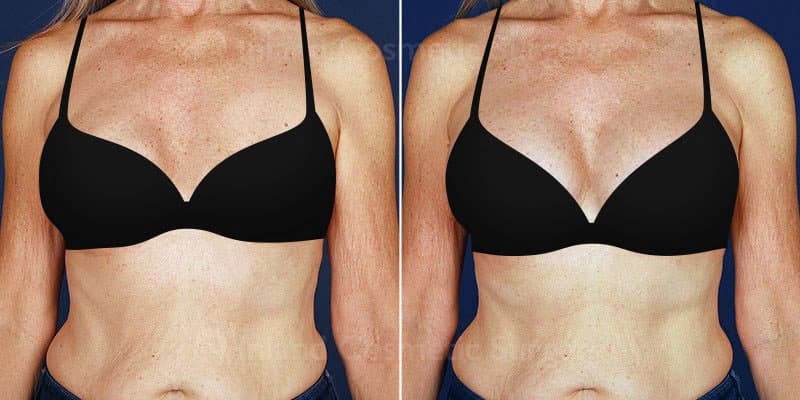 Case Study: Saline Breast Augmentation in Thin Women - Explore Plastic  Surgery