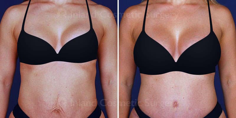 Real patient shown before and after tummy tuck body contouring and breast revision with Dr. Haiavy
