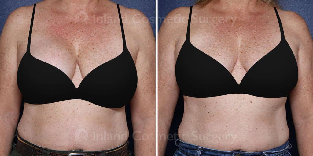 Patient shown before and after breast revision with a removal and breast lift. 