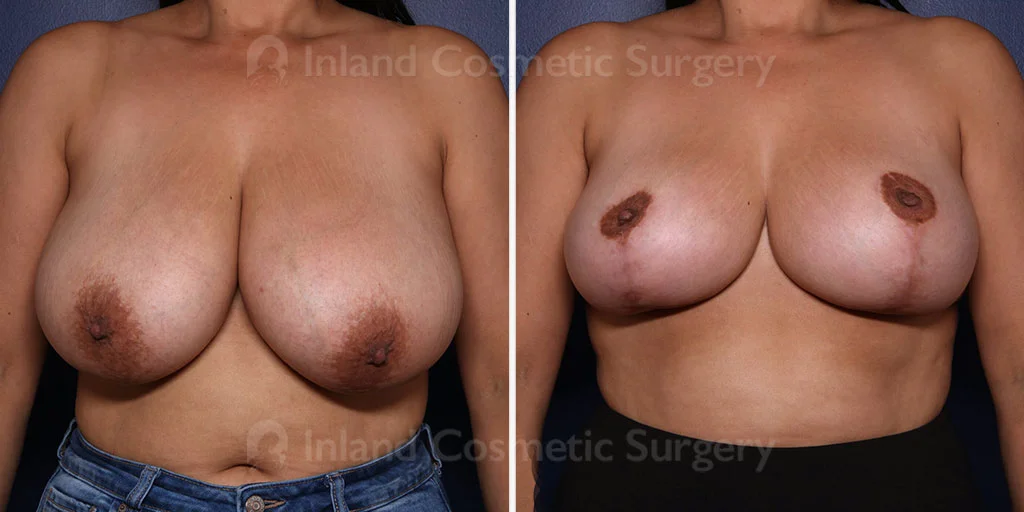 Breast Reduction with Lift