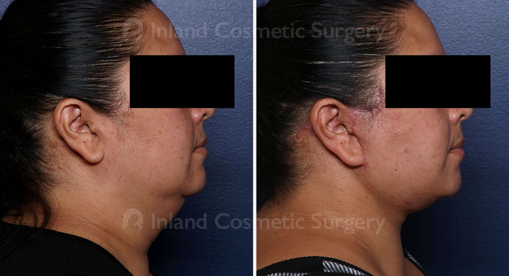 Lower Facelift & Neck Lift