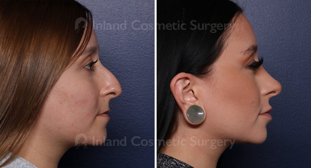 Rhinoplasty & Septoplasty