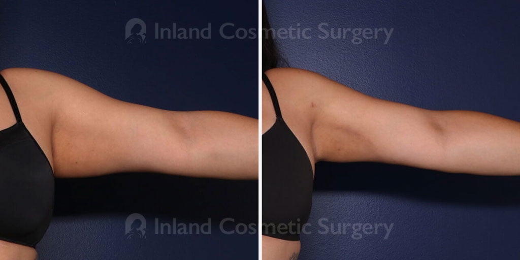 Liposuction Upper Arms