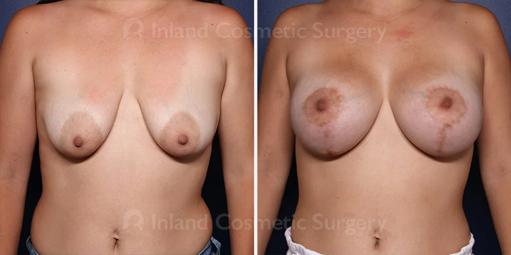 Breast Lift with Augmentation