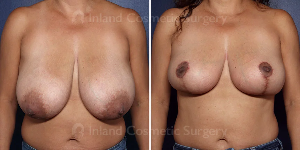 Breast Reduction with Lift