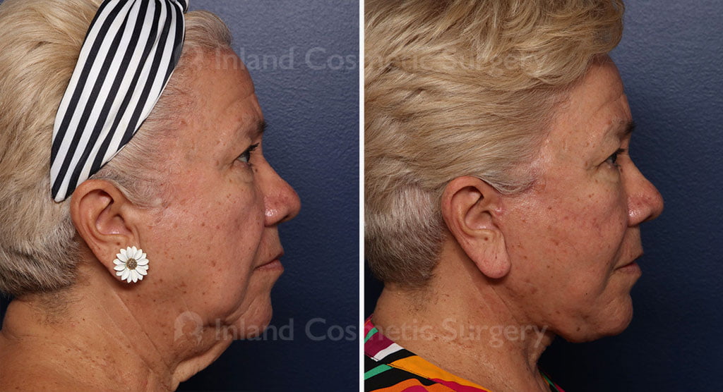 Female patient before and after a face and neck lift with fat transfer and buccal fat pad removal