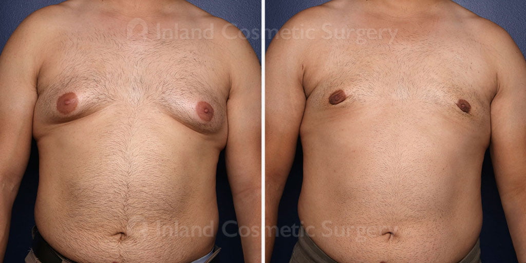 Male Breast Reduction