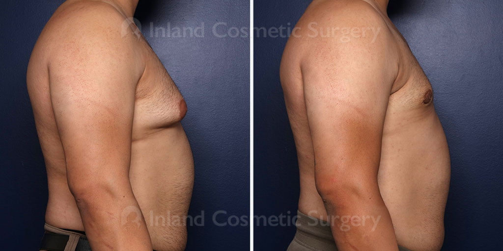 Before and after male breast reduction
