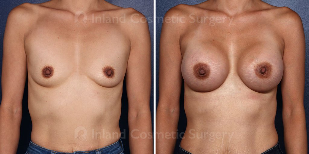 Breast Augmentation