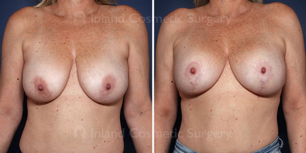Breast Lift with Augmentation