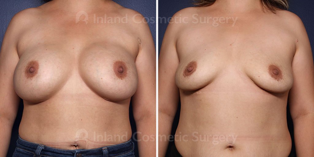 Breast Implant Removal