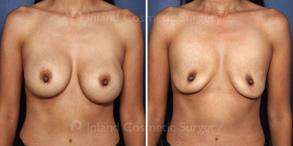 Breast Implant Removal