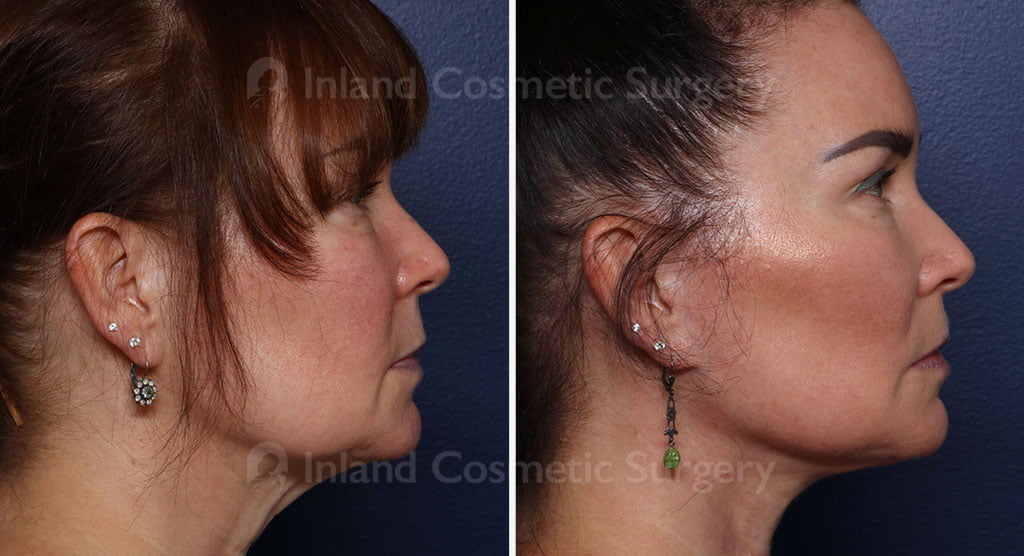 Face Lift, Neck Lift, & Buccal Fat Extraction