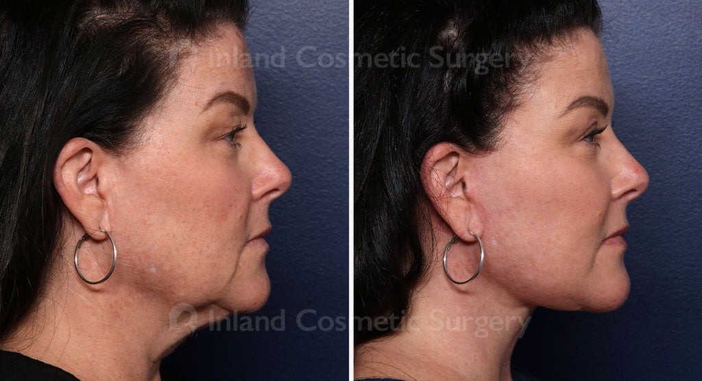 Before and after facelift and eyelid lift with neck lift and fat grafting