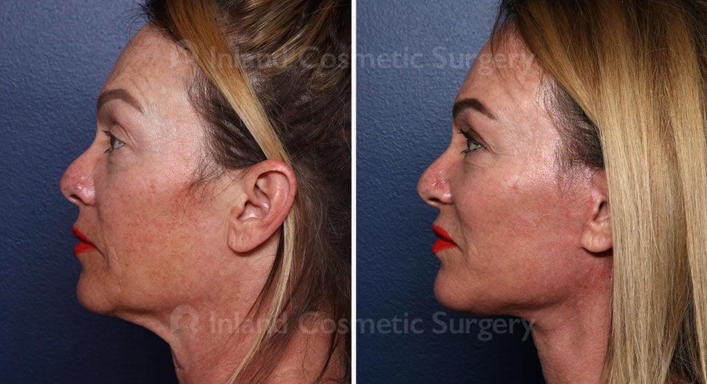 Female patient before and after facelift, neck lift, and fat transfer