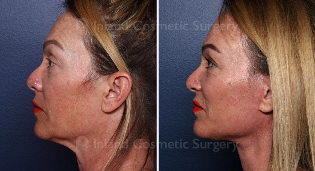 Face Lift, Neck Lift, & Fat Transfer