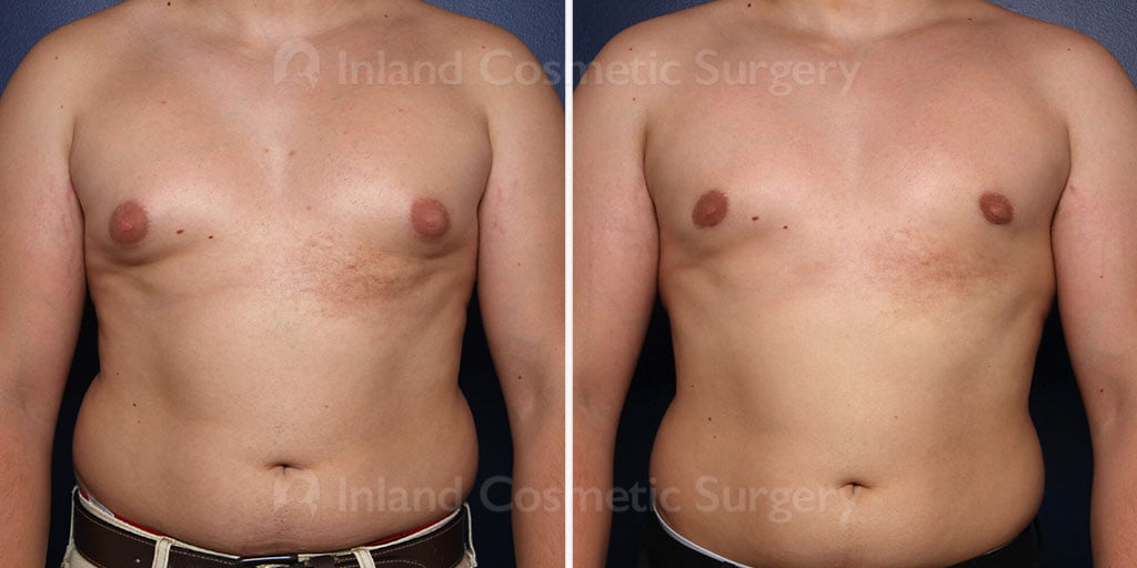 Male Breast Reduction