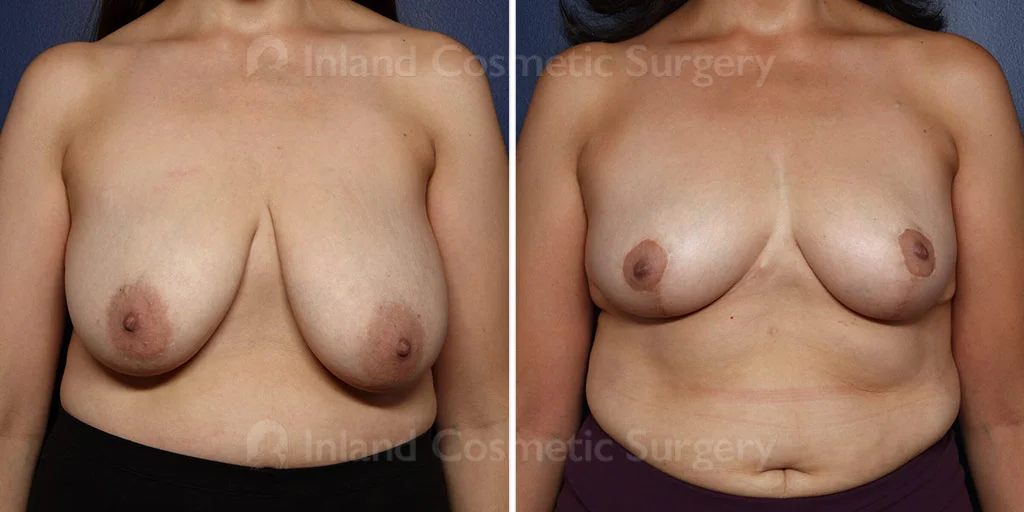 Breast Reduction