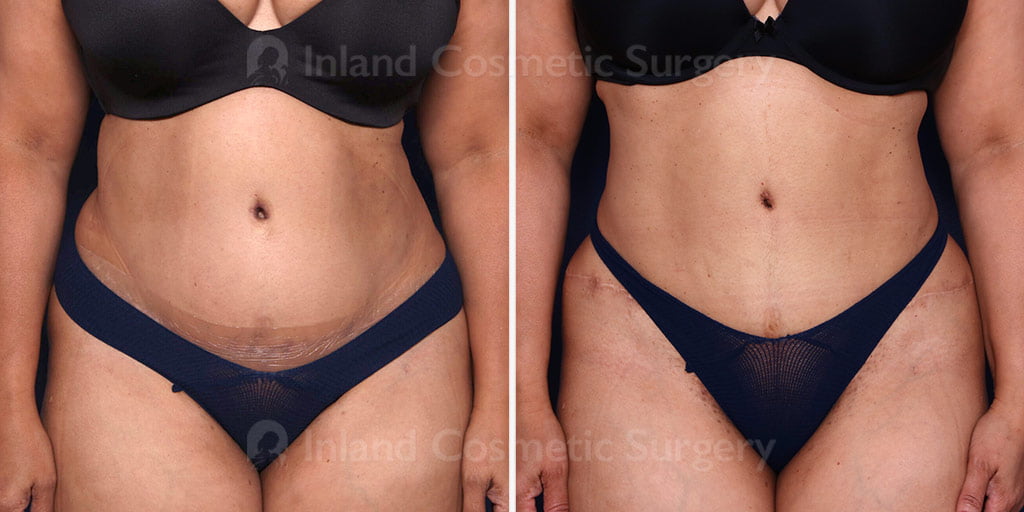 Vaser Liposuction