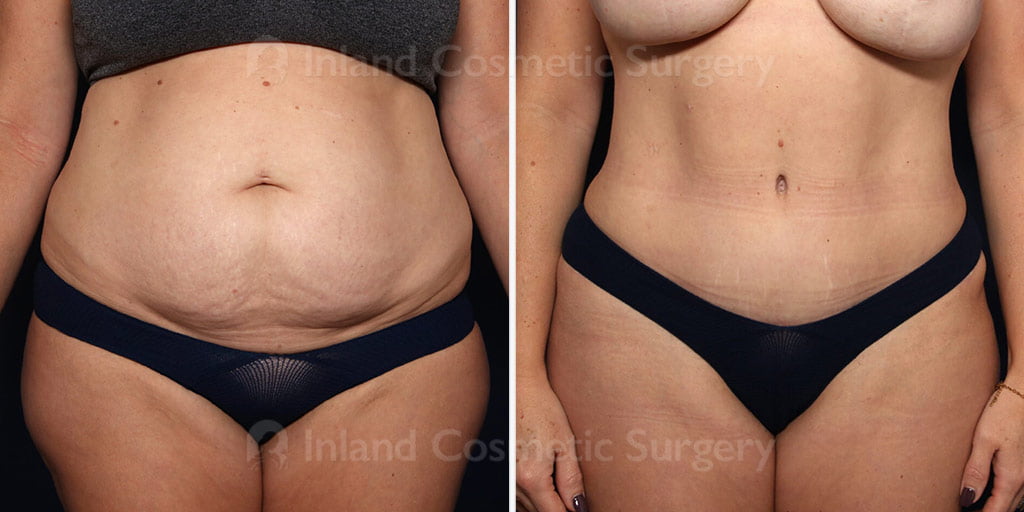 Tummy Tuck with Liposuction