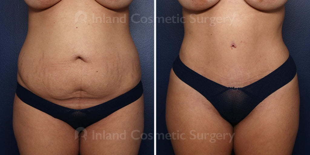 Tummy Tuck with Liposuction