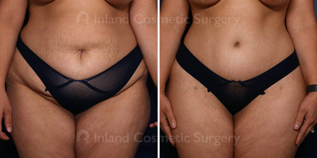 Tummy Tuck with Liposuction