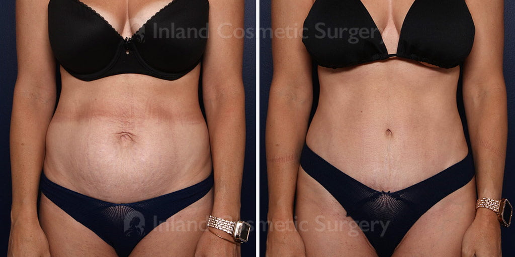 Tummy Tuck with Liposuction