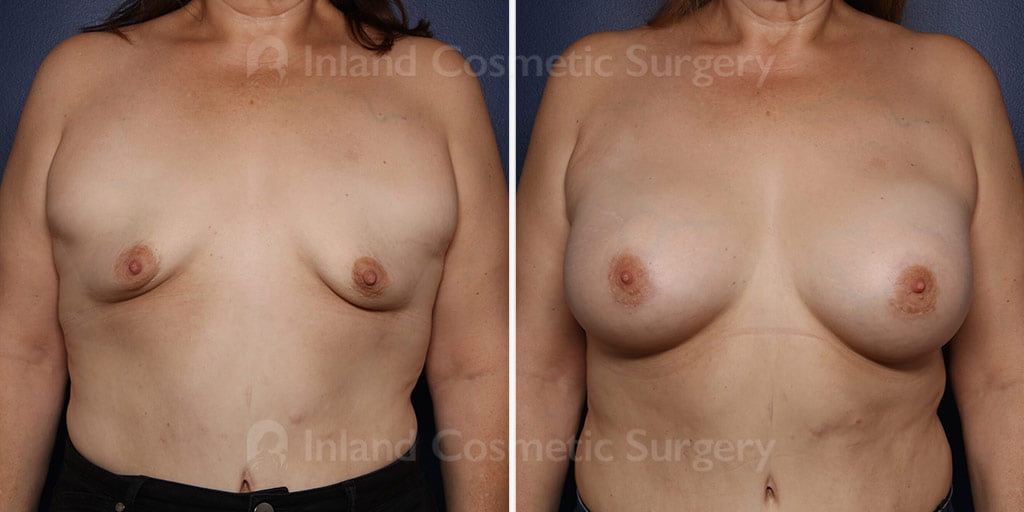 Breast Augmentation with liposuction of the axillary