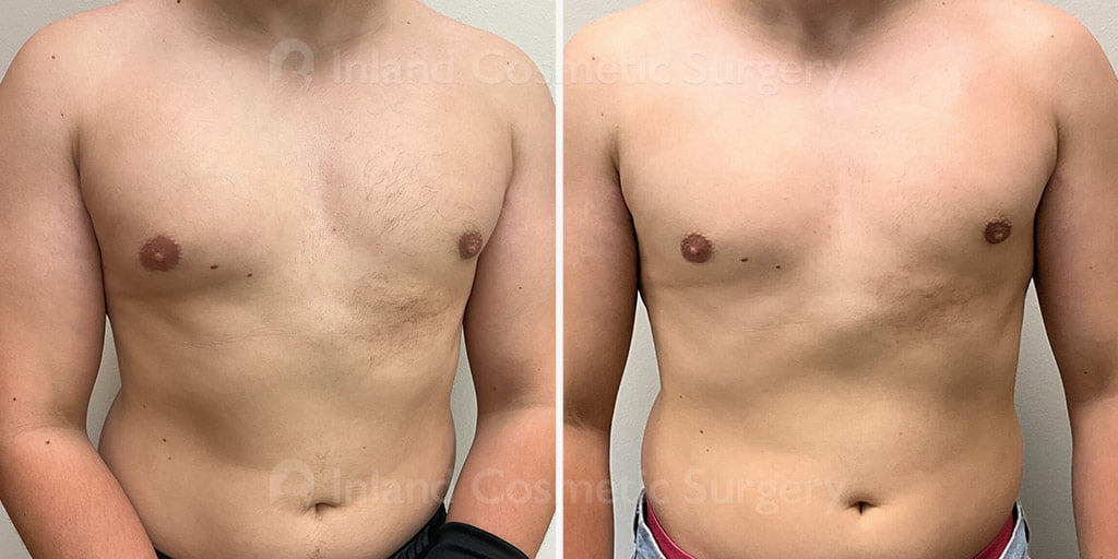 Male Chest Contouring