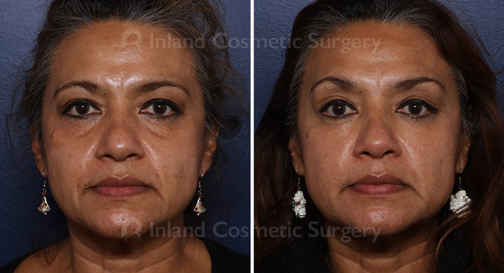 Before and after lower eyelid surgery