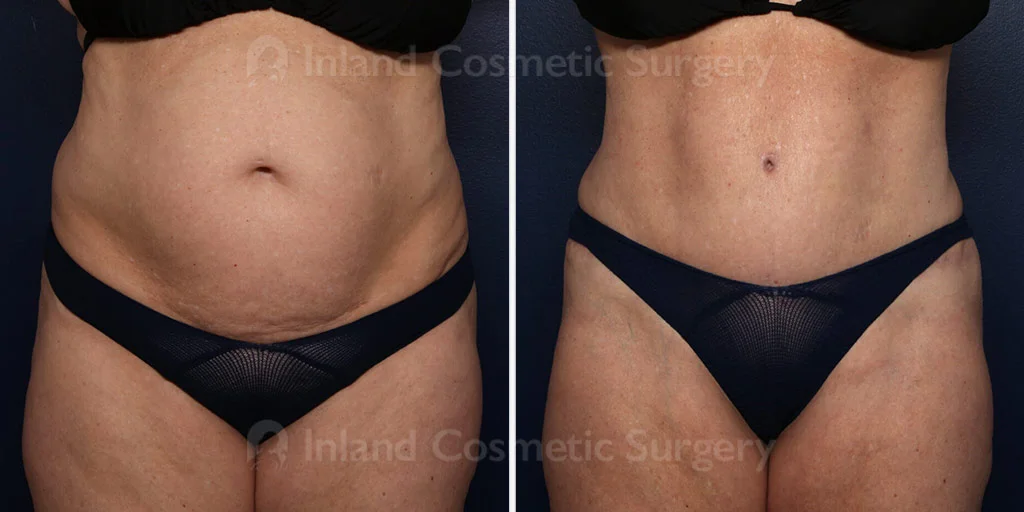 Tummy Tuck