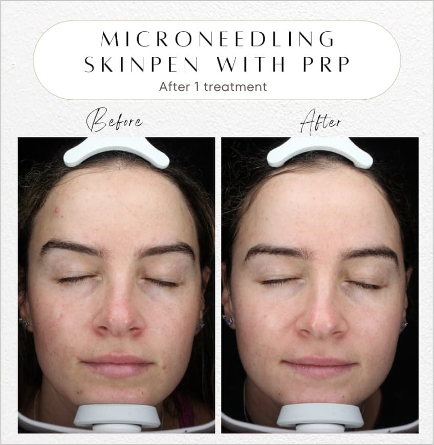 Rancho Cucamonga med spa patient shown before and after 1 treatment of SkinPen microneedling with PRP