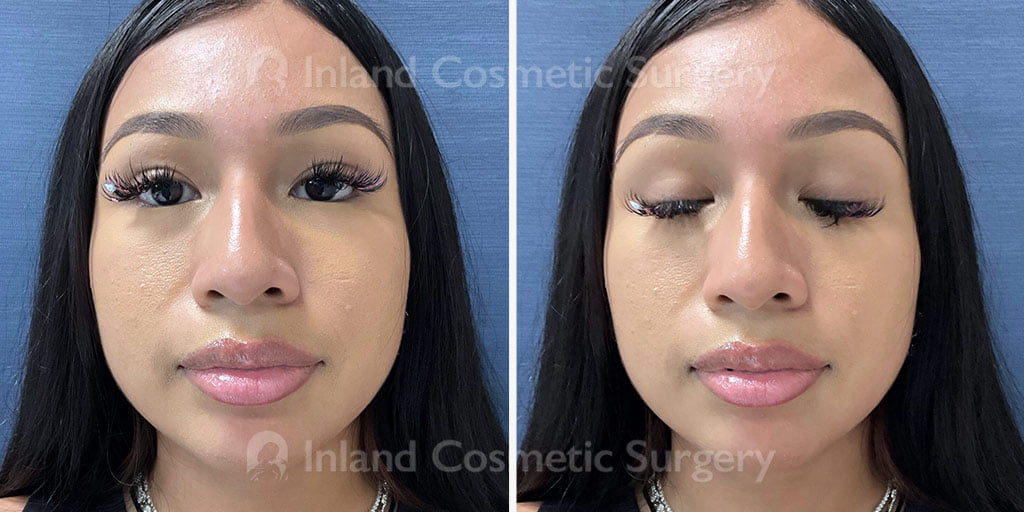 Non-Surgical Rhinoplasty