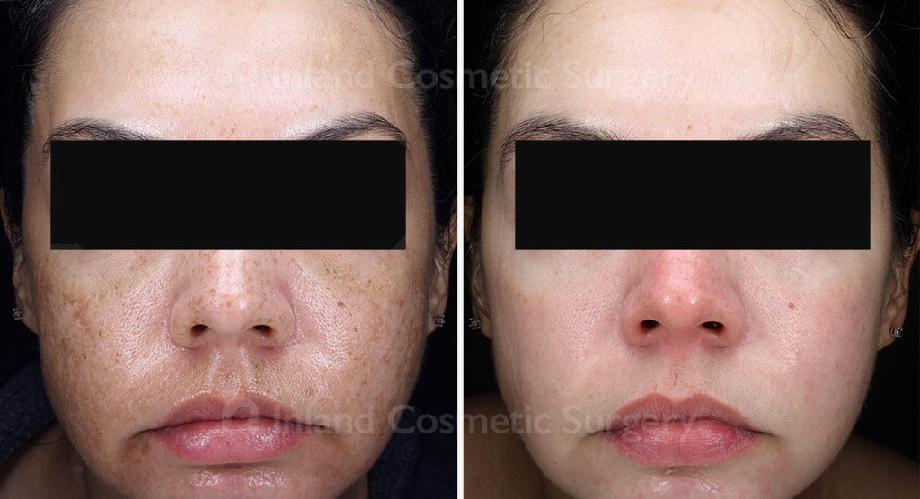 Skin Resurfacing