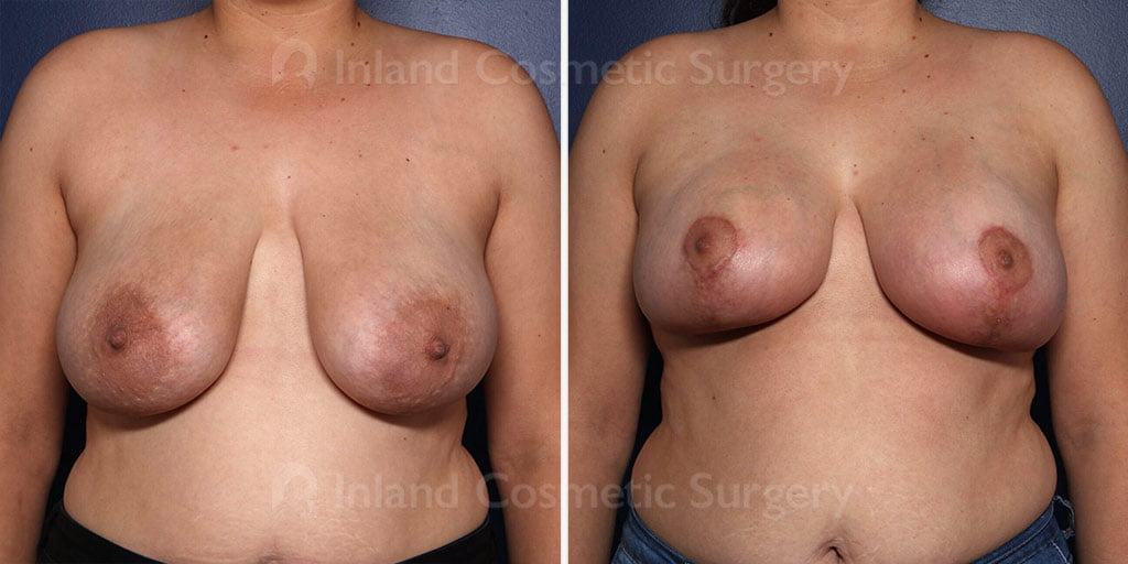 Breast Lift with Augmentation