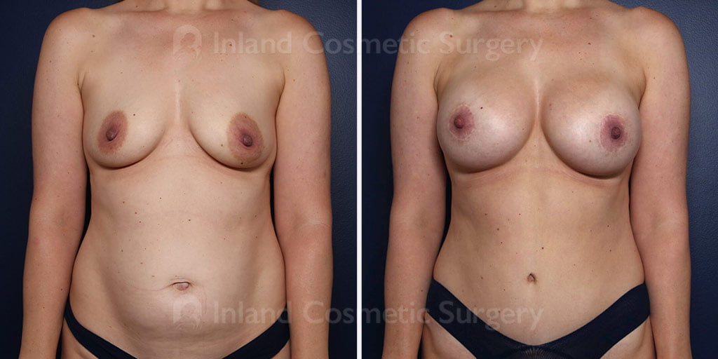 Breast Lift with Implants